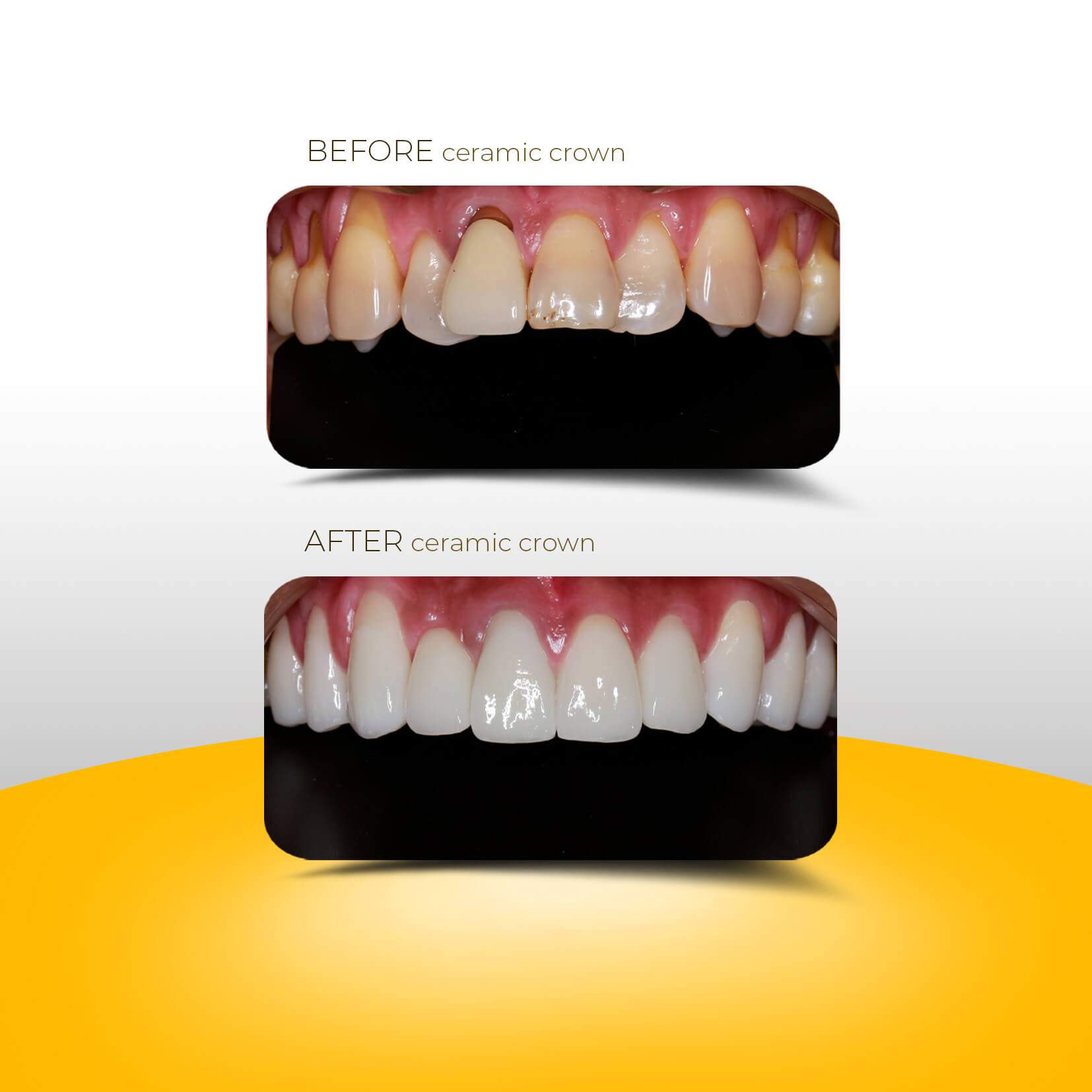 CERAMIC CROWN CERAMIC VENEER 3C Dental SPECIALIZING IN BRACES