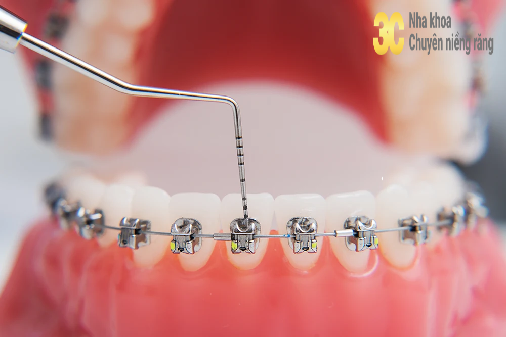 Siết răng khi niềng là gì?