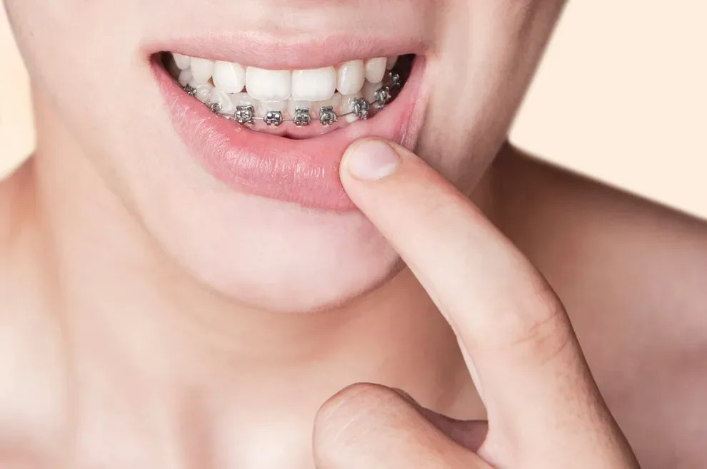 Có thể niềng răng một hàm được không?