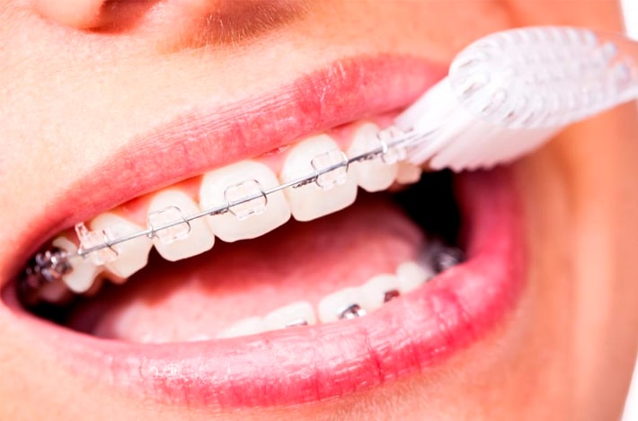 Tầm quan trọng của vệ sinh răng niềng