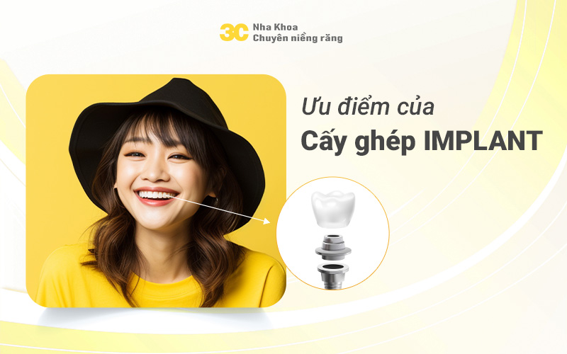 Ưu điểm của trồng răng Implant