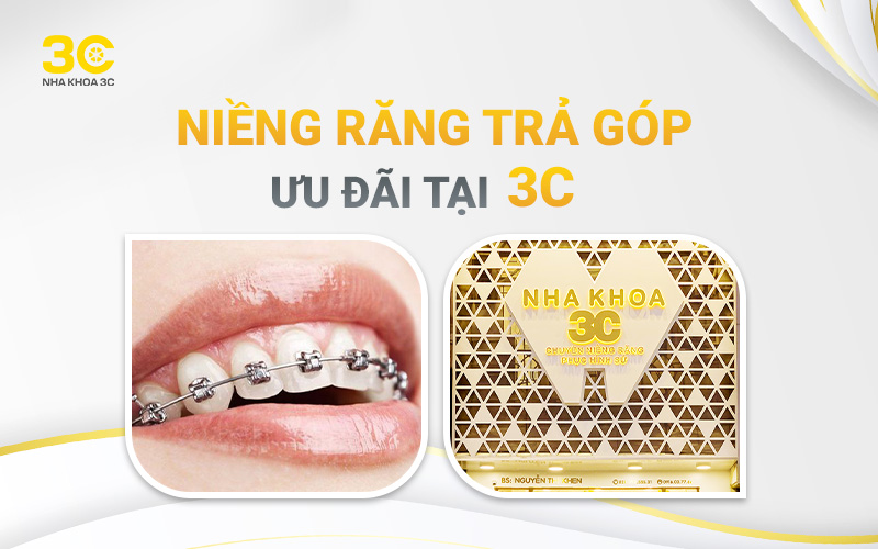 Niềng răng trả góp tại Nha Khoa 3C