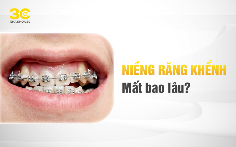 Niềng răng khểnh mất bao lâu?