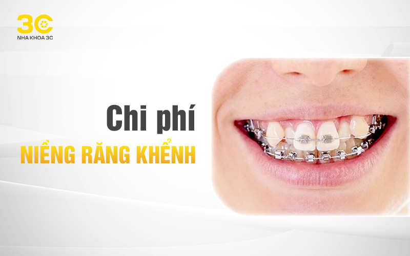 Chi phí niềng răng khểnh