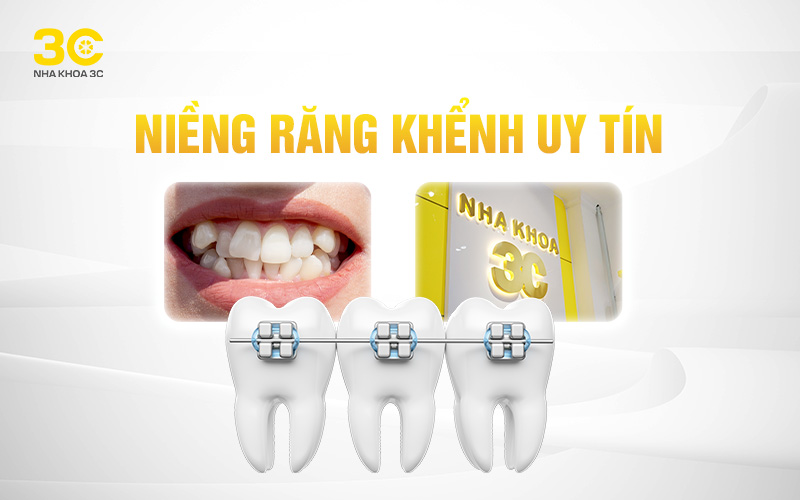 Niềng răng khểnh uy tín