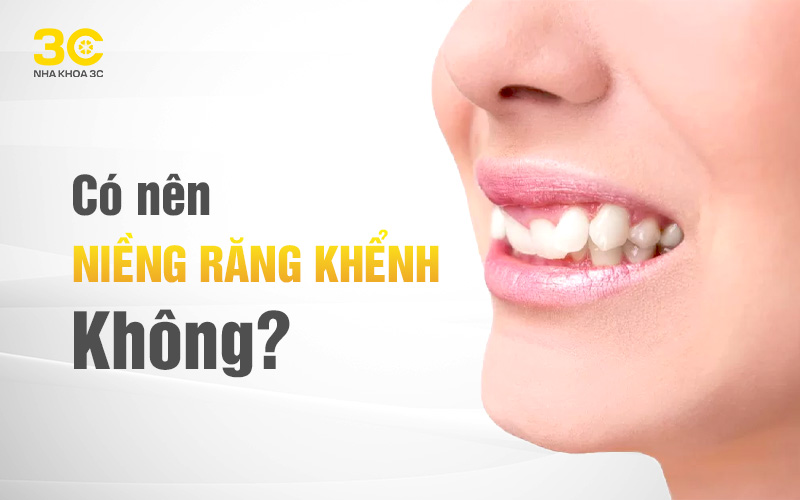 Có nên niềng răng khểnh hay không ?