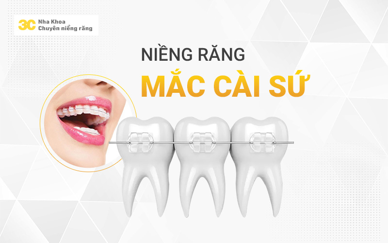 Niềng răng mắc cài sứ