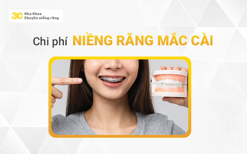 Chi phí niềng răng mắc cài