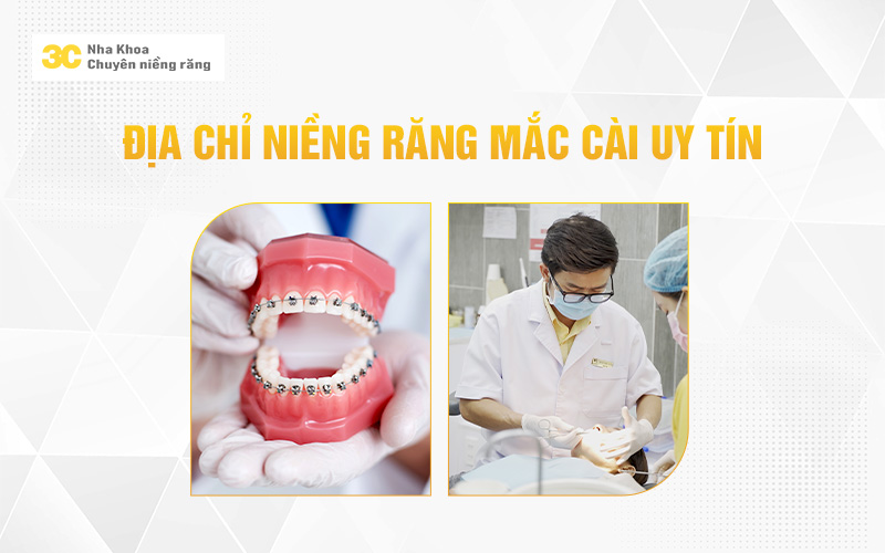 Địa chỉ niềng răng mắc cài uy tín
