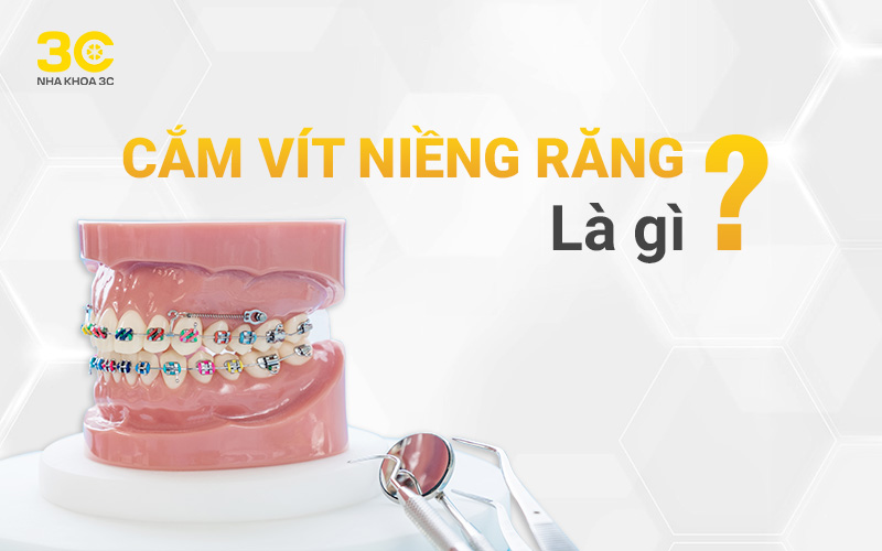 Cắm vít niềng răng là gì?