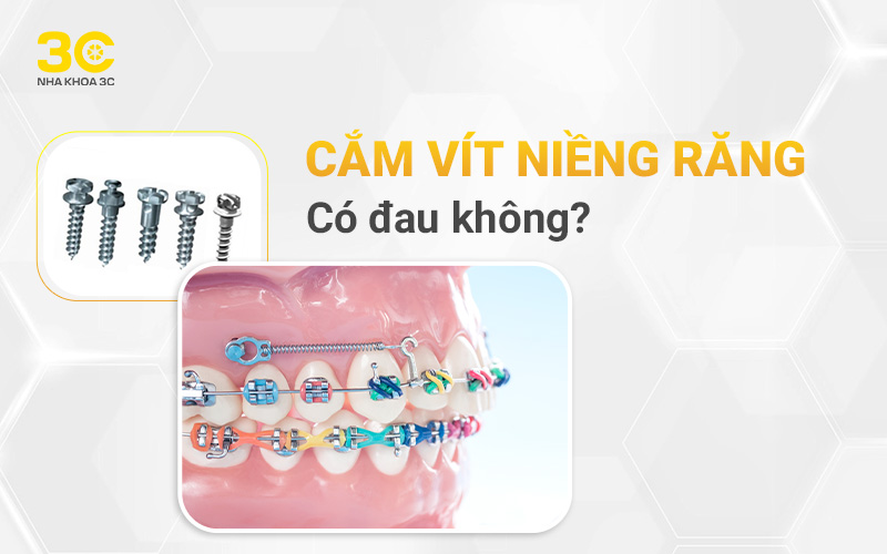 Cắm vít niềng răng có đau không?