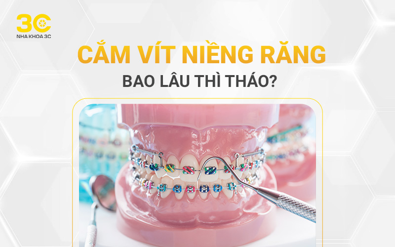 Cắm vít niềng răng bao lâu thì tháo?