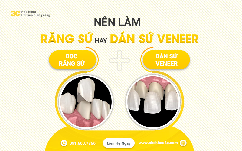 Nên làm răng sứ hay dán veneer tốt hơn | Nha Khoa 3C