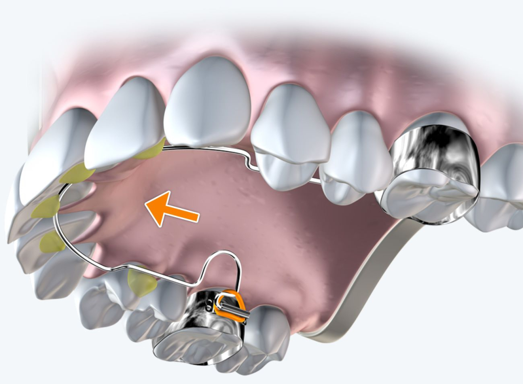 Kiến thức niềng răng - Nha Khoa 3C