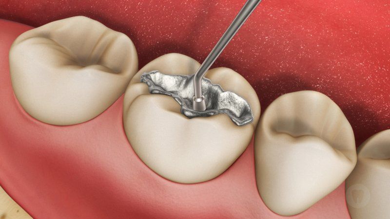 Trám răng phục hồi răng sâu bị vỡ