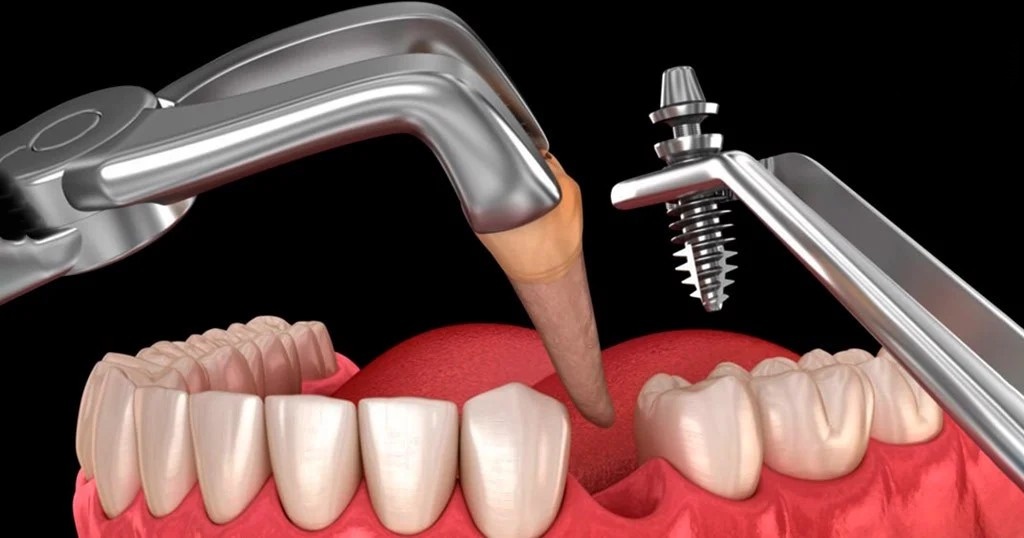 Trồng implant tức thì sau khi nhổ răng