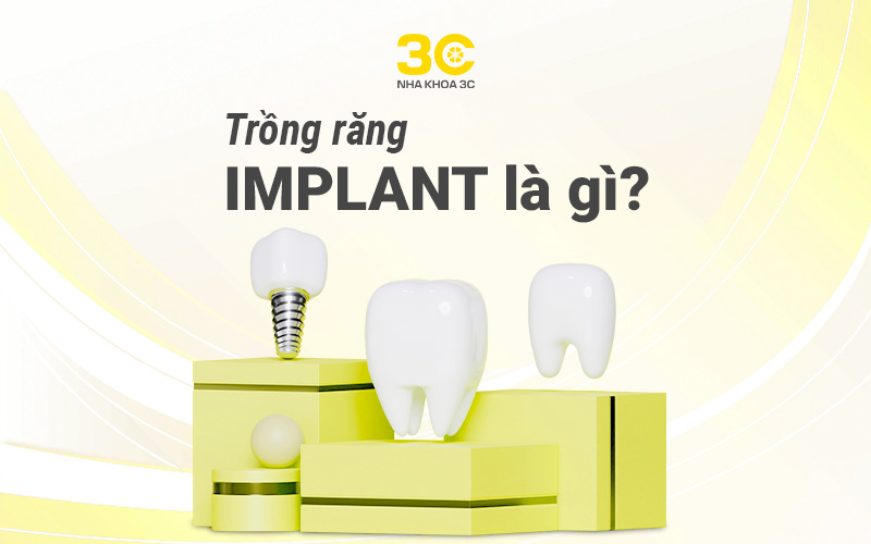 Chi phí trồng răng implant bao nhiêu tiền 2024