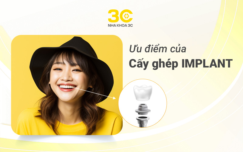 Ưu điểm của cấy ghép Implant