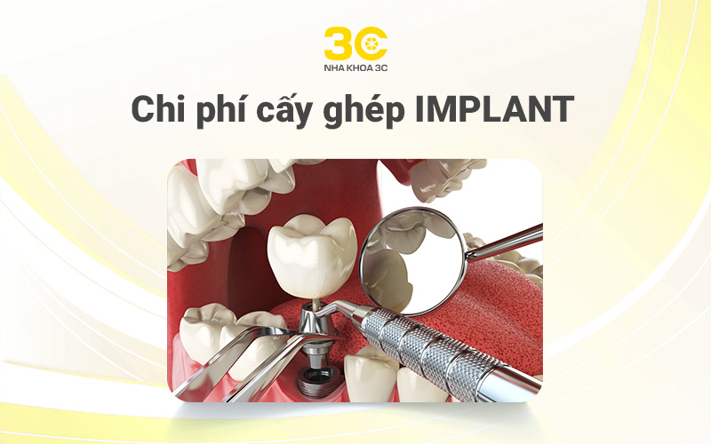 Chi phí cấy ghép implant