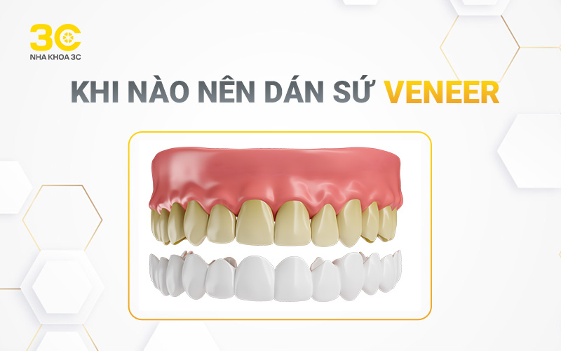 Khi nào thì nên dán sứ Veneer?