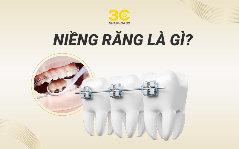 Niềng răng là gì?
