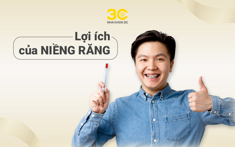 Lợi ích của niềng răng