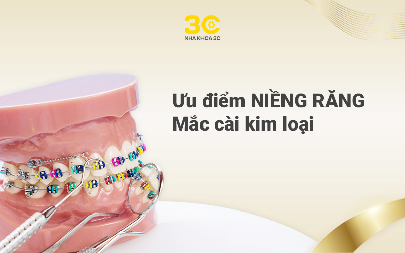 Ưu điểm niềng răng mắc cài kim loại