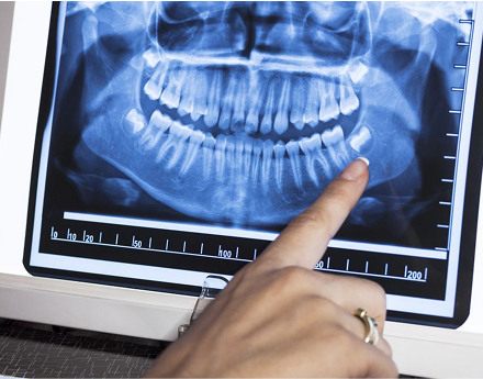 Trám răng - Nha Khoa 3C