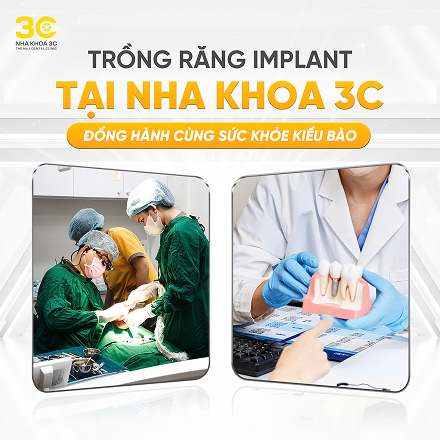 Niềng răng: Giải đáp chi tiết mọi thắc mắc từ A - Z 