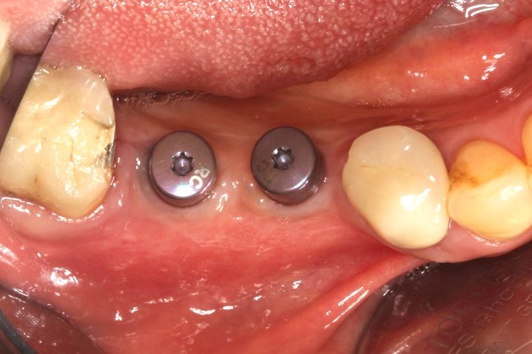 Dental Implant - Nha Khoa 3C
