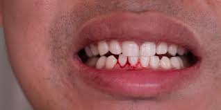 Periodontal treatment - Nha Khoa 3C