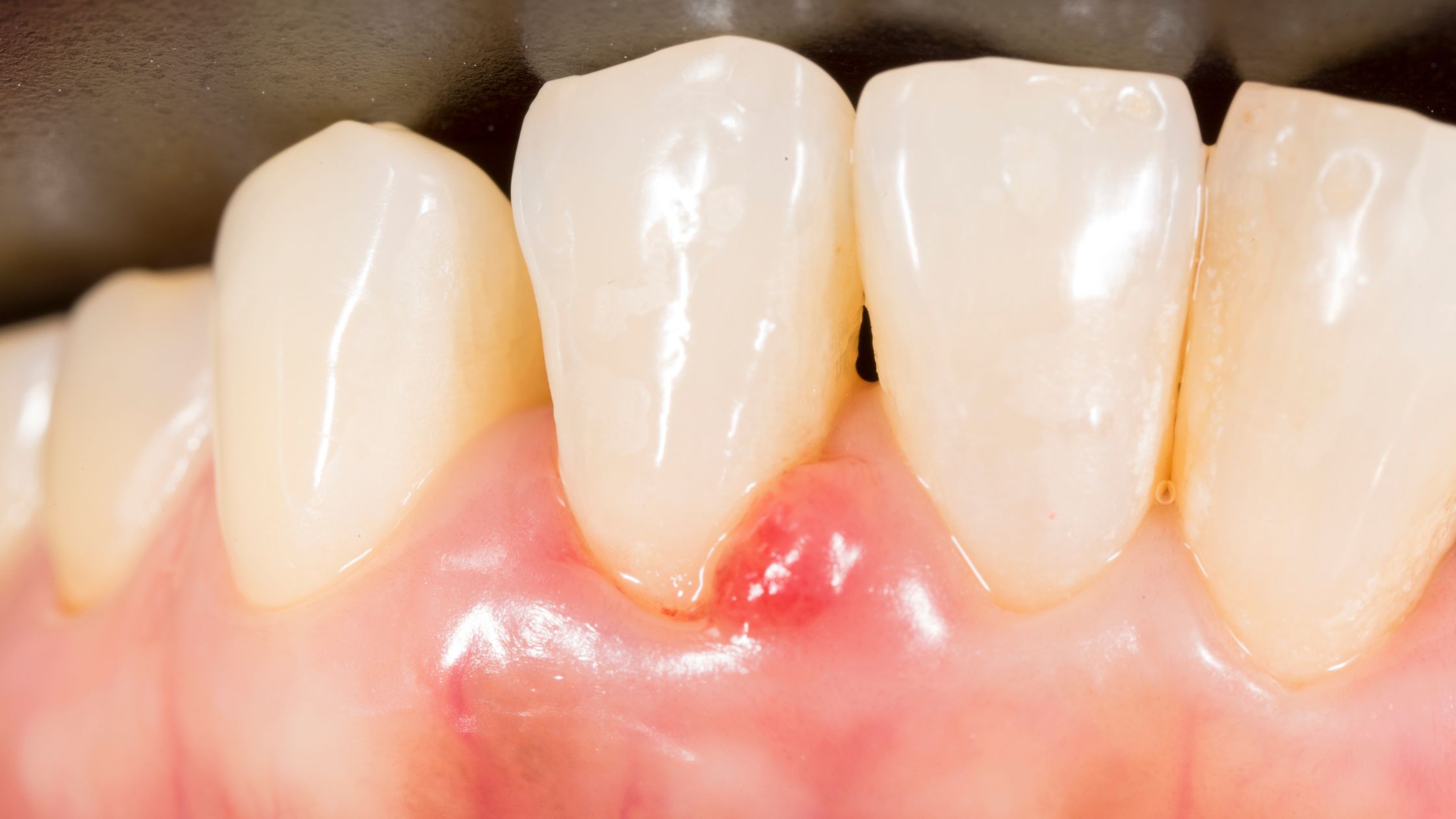 Periodontal treatment - Nha Khoa 3C
