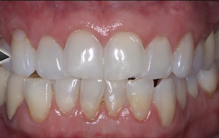 Periodontal treatment - Nha Khoa 3C