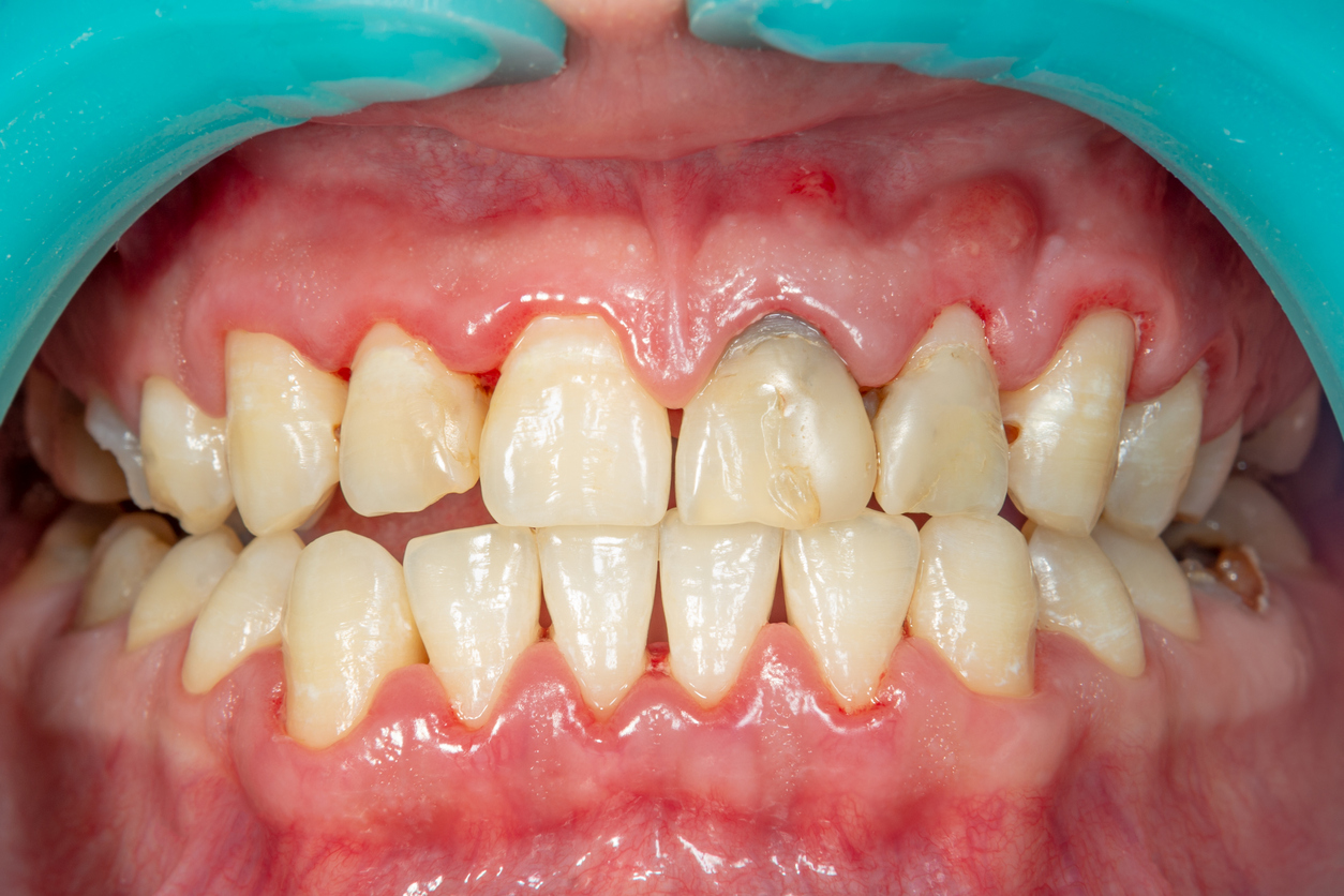Periodontal treatment - Nha Khoa 3C