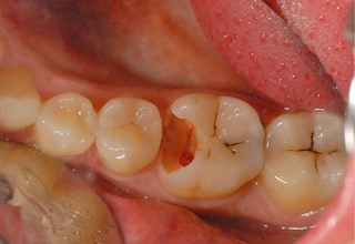 Root Canal Treatment - Nha Khoa 3C