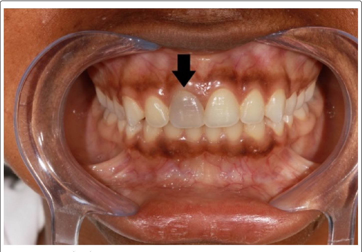 Root Canal Treatment - Nha Khoa 3C