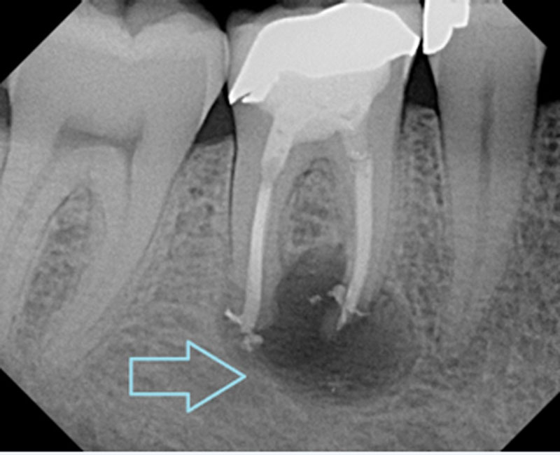 Root Canal Treatment - Nha Khoa 3C