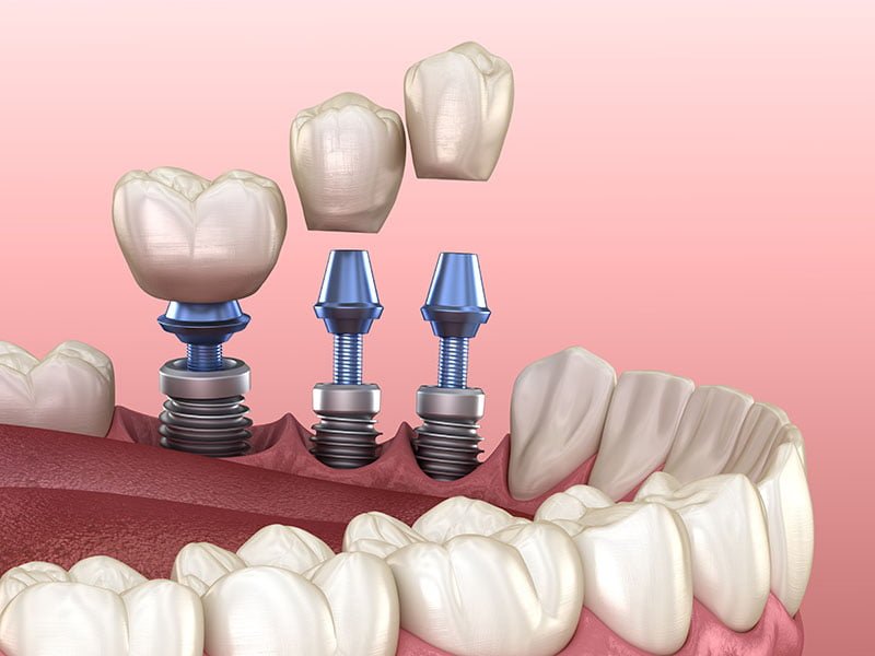 Dental Implant - Nha Khoa 3C