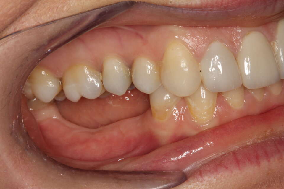 Dental Implant - Nha Khoa 3C