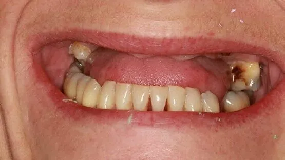 Dental Implant - Nha Khoa 3C