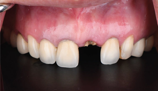 Dental Implant - Nha Khoa 3C