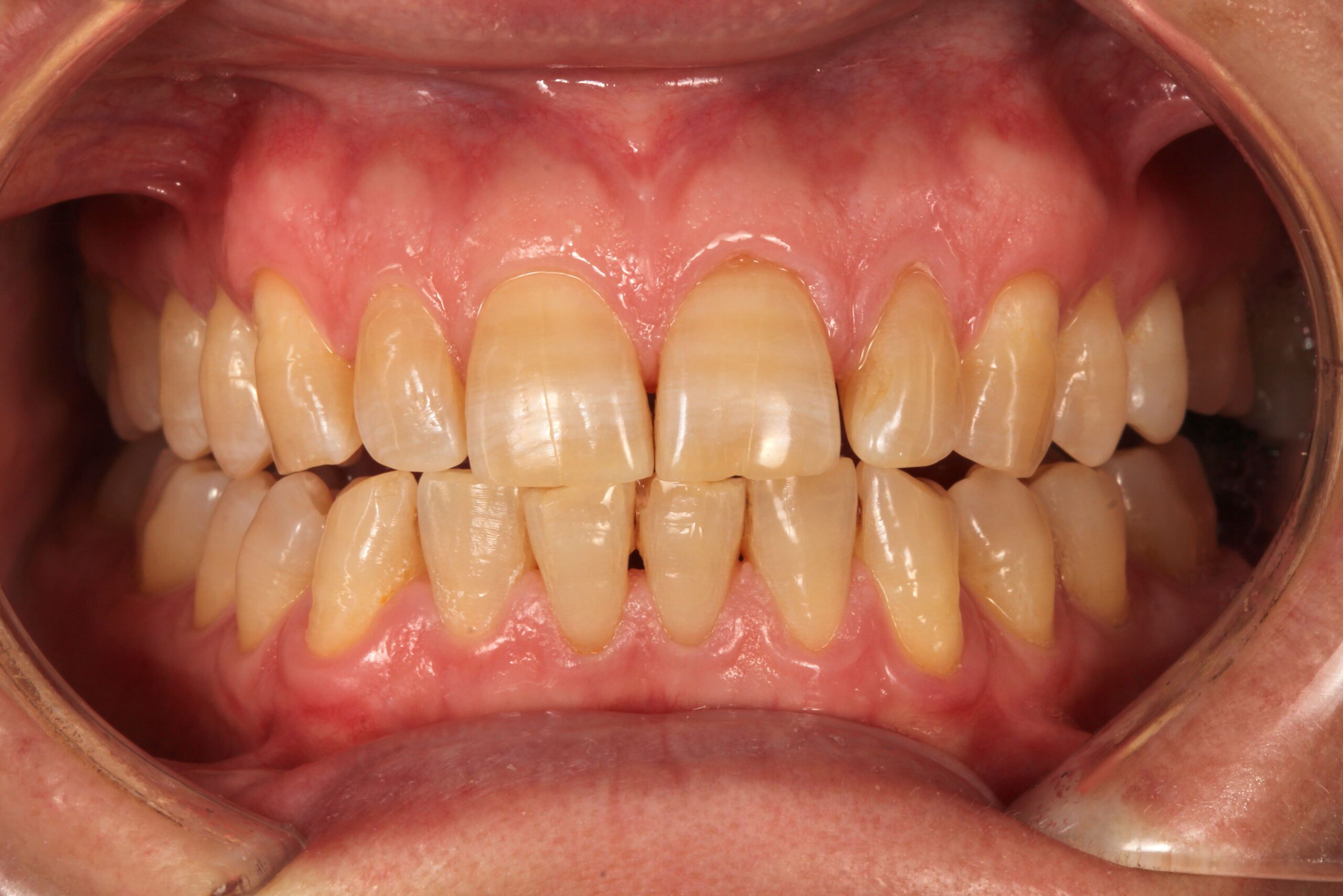 Teeth Whitening - Nha Khoa 3C