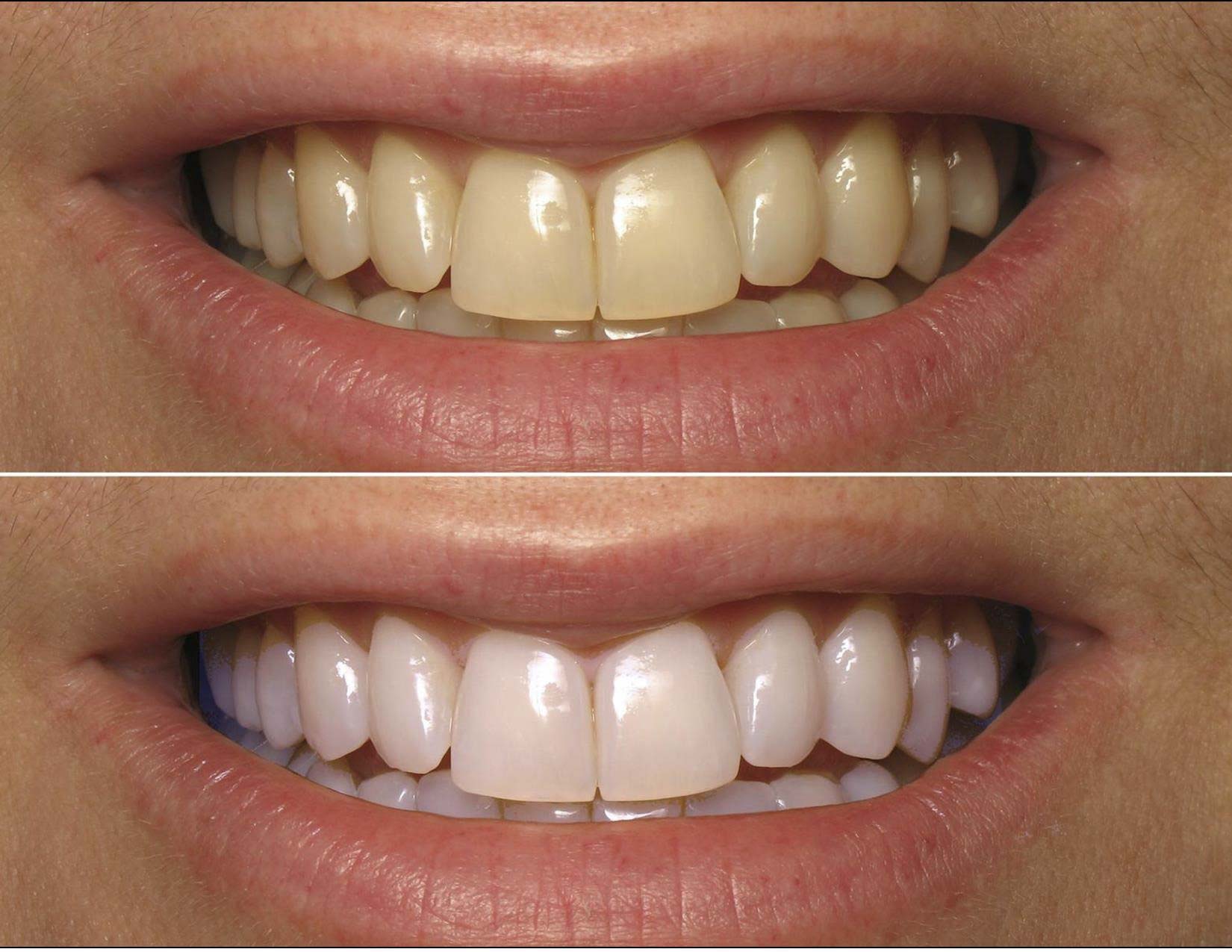 Teeth Whitening - Nha Khoa 3C