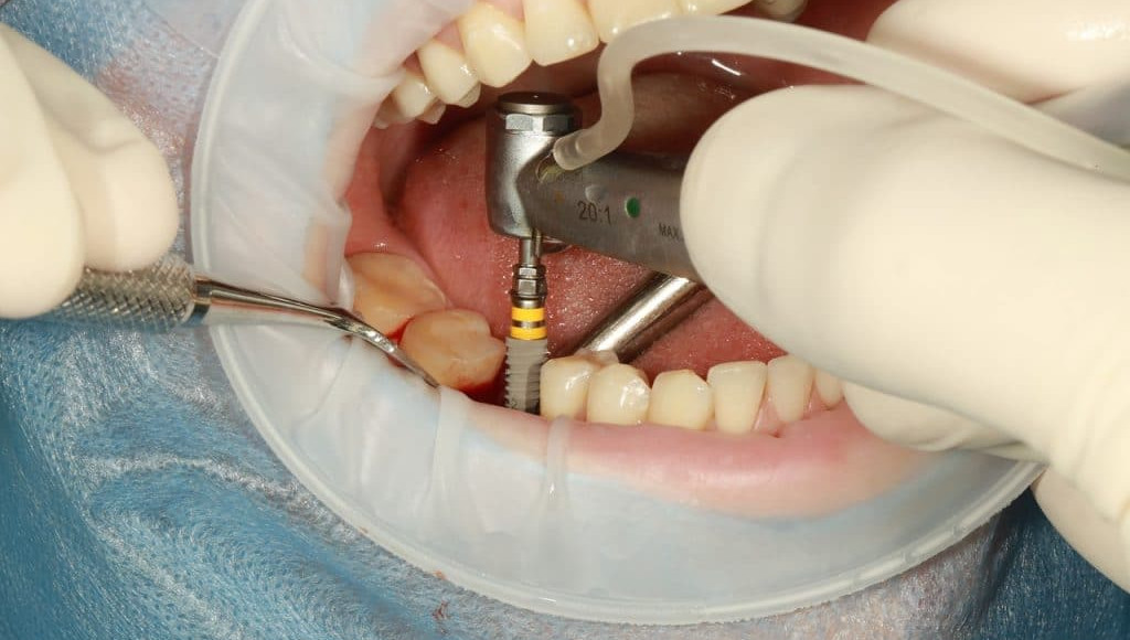Dental Implant - Nha Khoa 3C