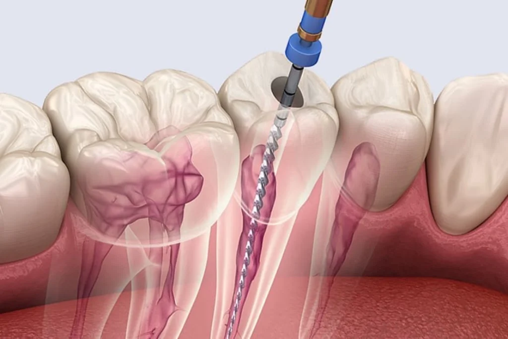 Root Canal Treatment - Nha Khoa 3C