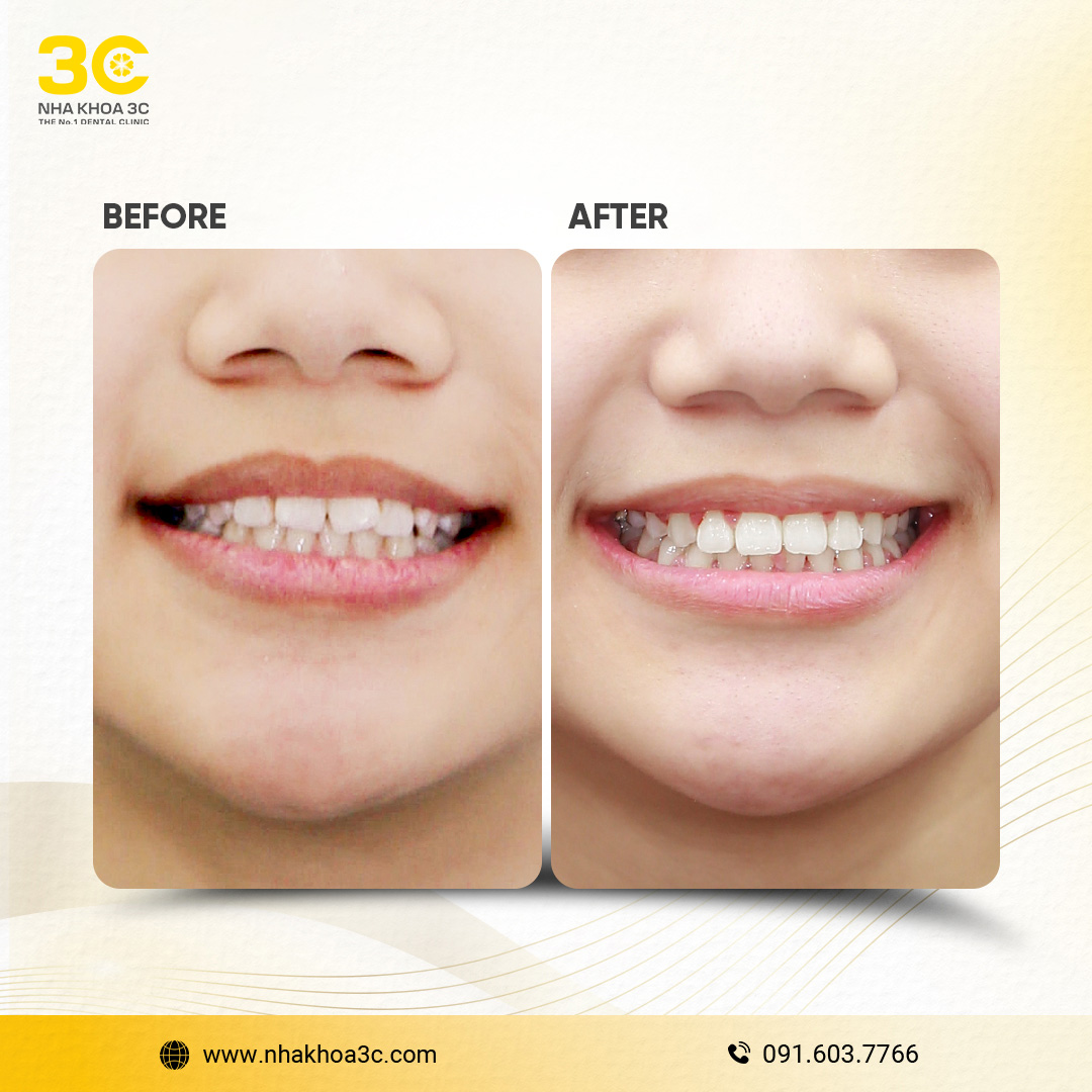 Trần Bửu Liên - Niềng răng mắc cài kim loại