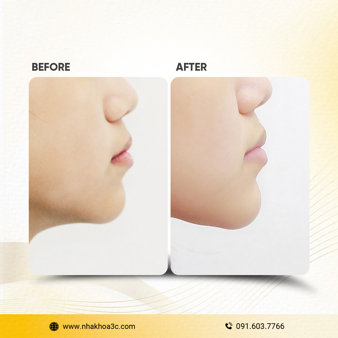 Trần Bửu Liên - Niềng răng mắc cài kim loại