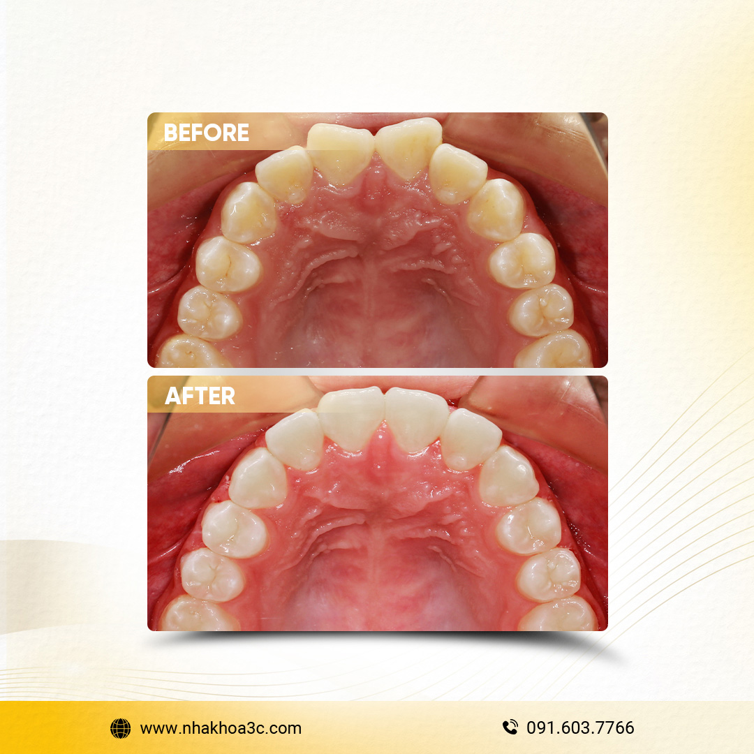 Trần Bửu Liên - Niềng răng mắc cài kim loại