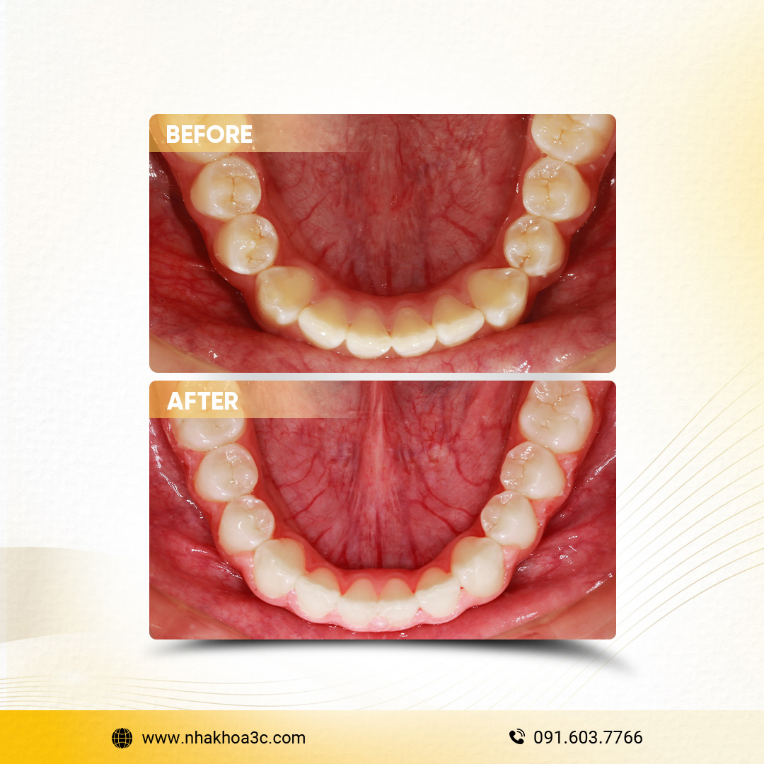 Trần Bửu Liên - Niềng răng mắc cài kim loại