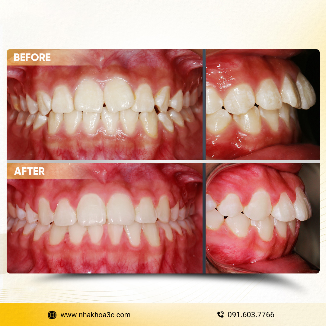 Trần Bửu Liên - Niềng răng mắc cài kim loại